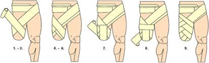 بانداژ استامپ بالای زانو ( Above knee bandaging) 
